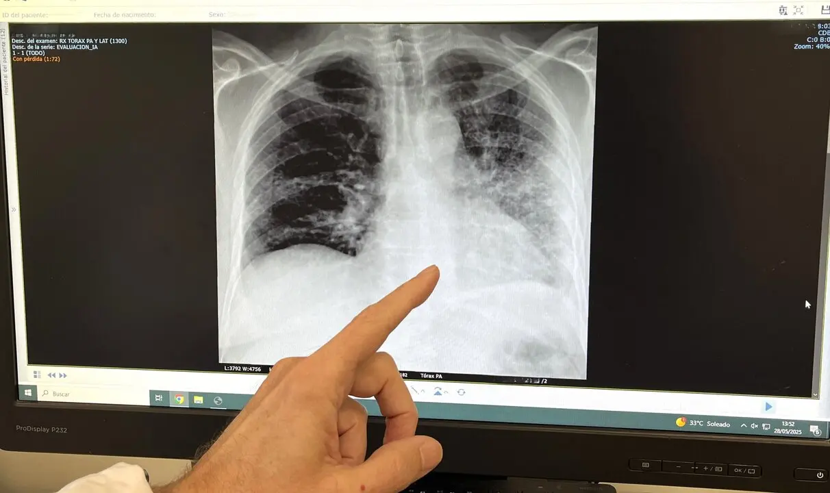 Foto RX paciente fumador con c&aacute;ncer de pulm&oacute;n