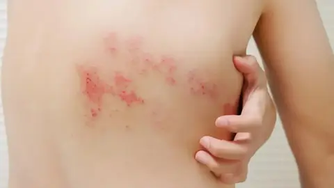 Herpes z&oacute;ster. Fuente: Clin&iacute;c Barcelona