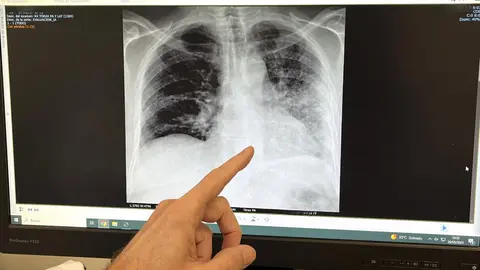 Foto RX paciente fumador con c&aacute;ncer de pulm&oacute;n