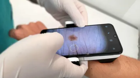 Dermatoscopio-Teledermatolog&iacute;a. Fuente: Quir&oacute;nsalud Huelva